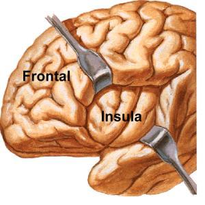 Changes to the function of the insula have been consistently implicated in depression at all stages of the illness