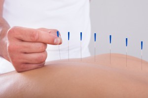 acupunture