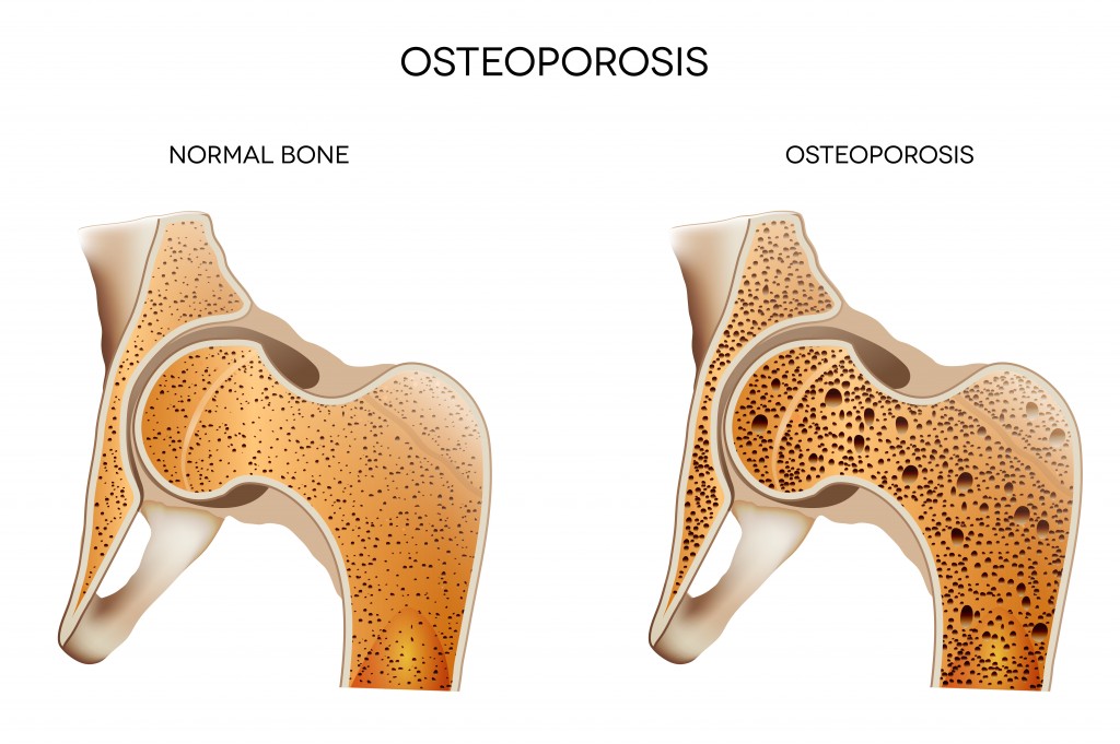 Osteoporosis affects around 3 million people in the UK.